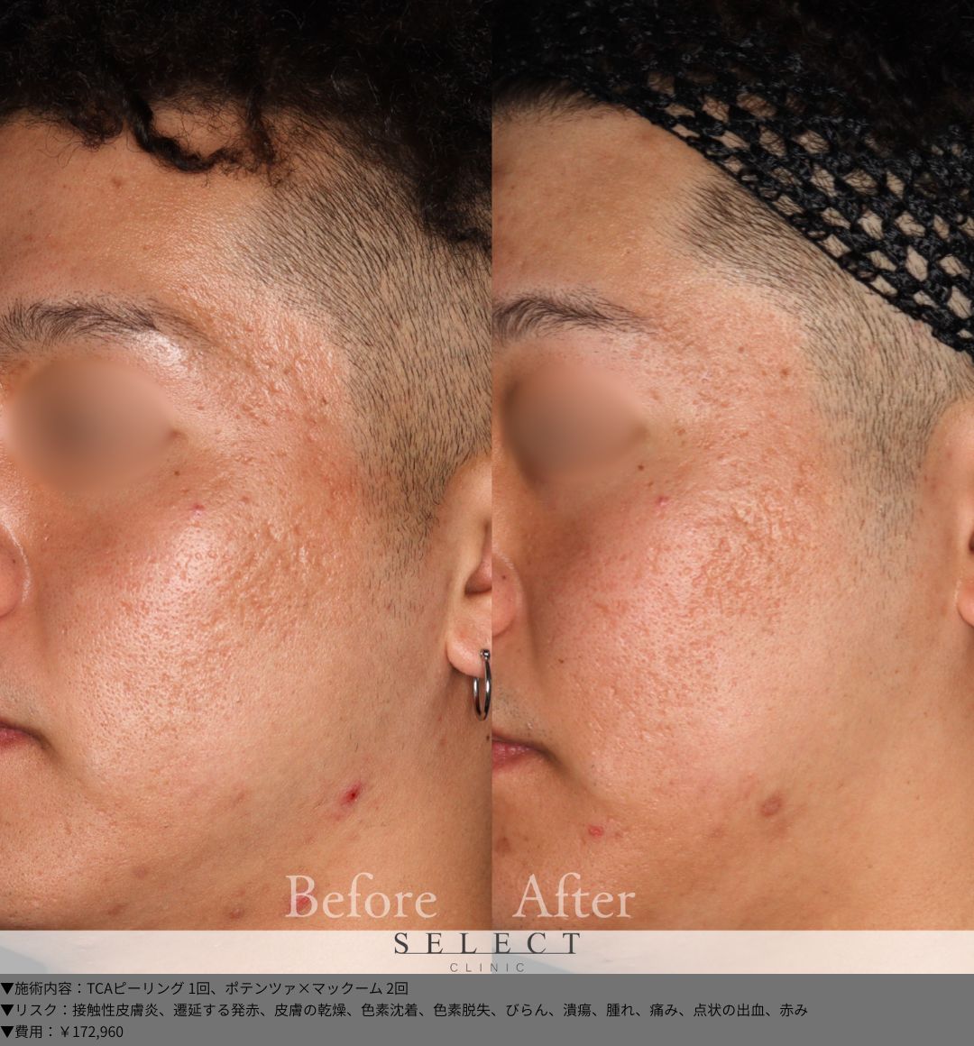 TCAピーリング1回 ポテンツァ×マックーム2回