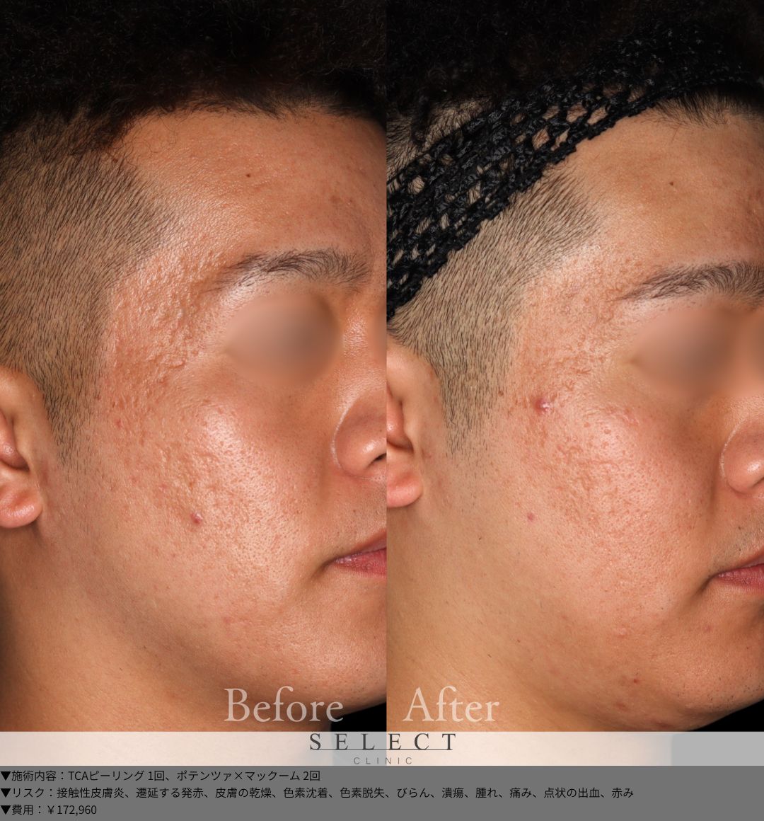 TCAピーリング1回 ポテンツァ×マックーム2回