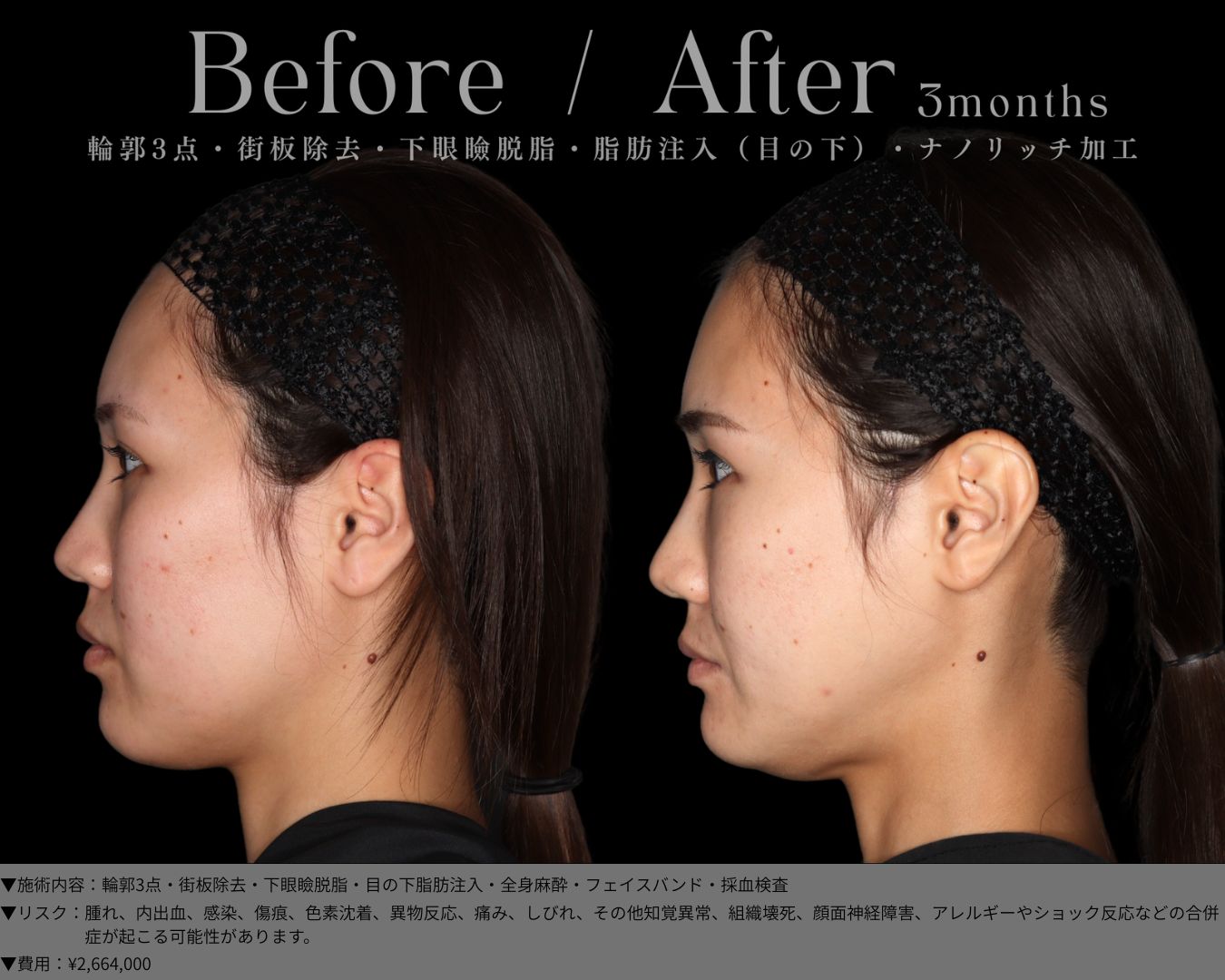 輪郭3点・街板除去・下眼瞼脱脂・目の下脂肪注入・全身麻酔・フェイスバンド・採血検査