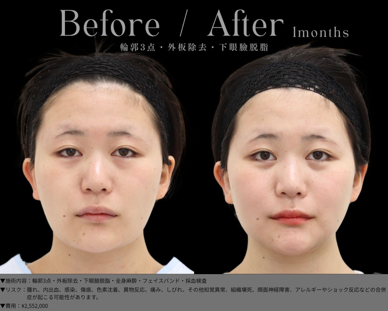 輪郭3点・外板除去・下眼臉脱脂・全身麻酔・フェイスバンド・採血検査