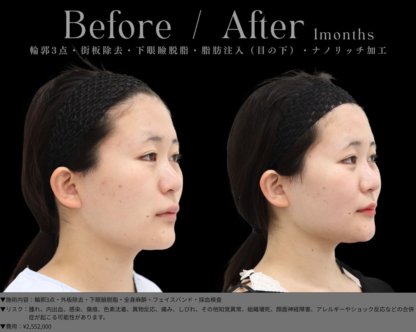 輪郭3点・外板除去・下眼臉脱脂・全身麻酔・フェイスバンド・採血検査