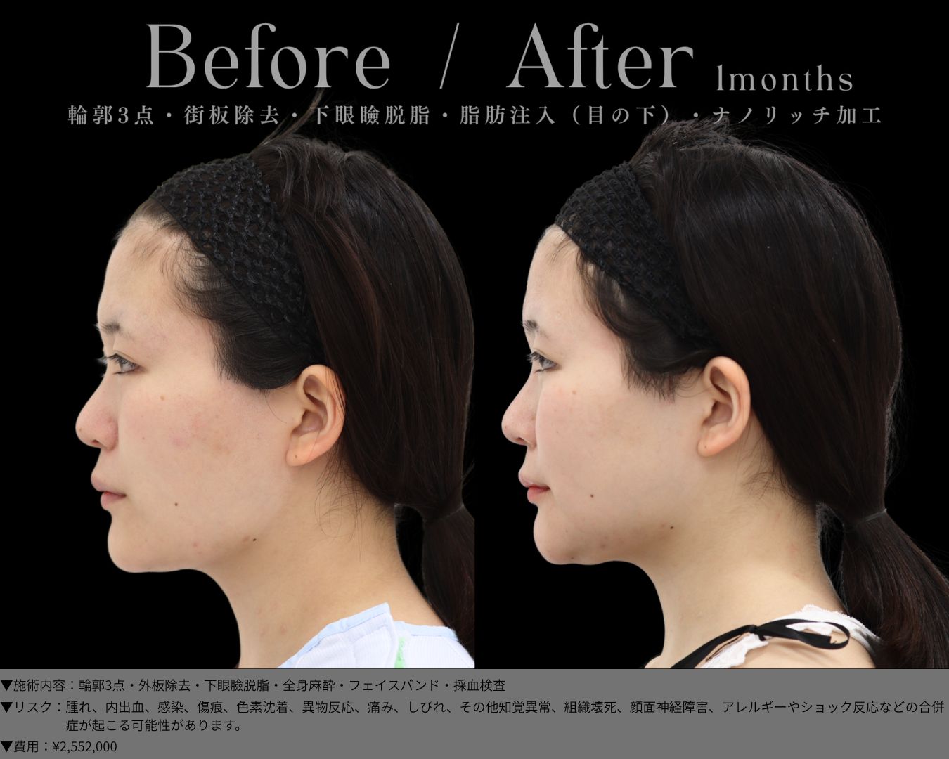 輪郭3点・外板除去・下眼臉脱脂・全身麻酔・フェイスバンド・採血検査