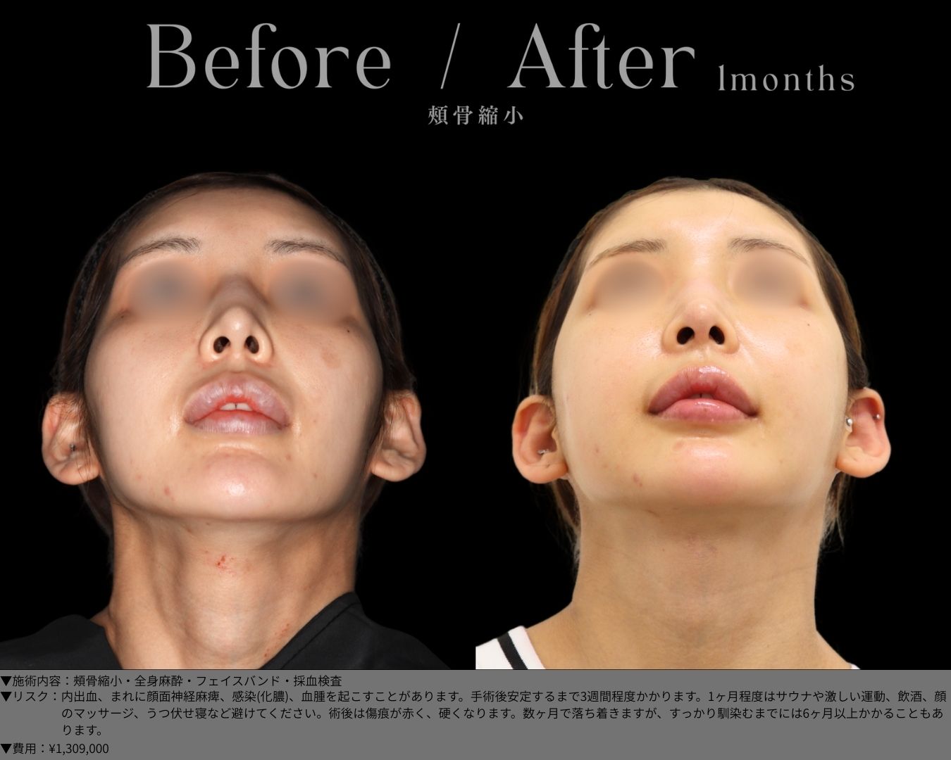 頰骨縮小・全身麻酔・フェイスバンド・採血検査