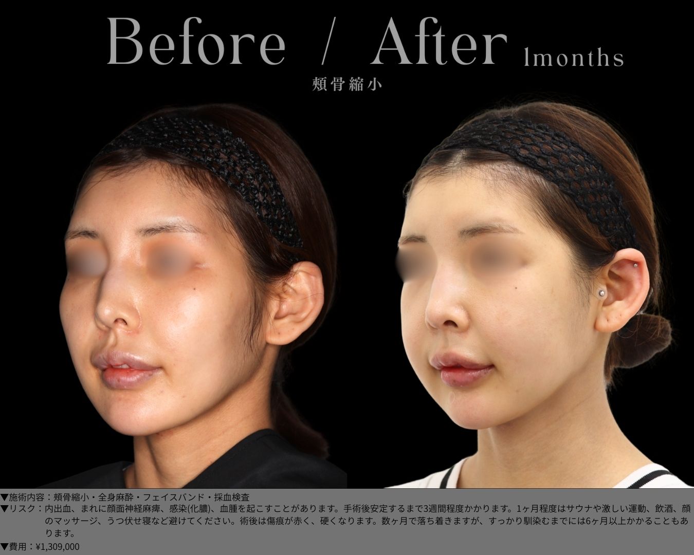 頰骨縮小・全身麻酔・フェイスバンド・採血検査