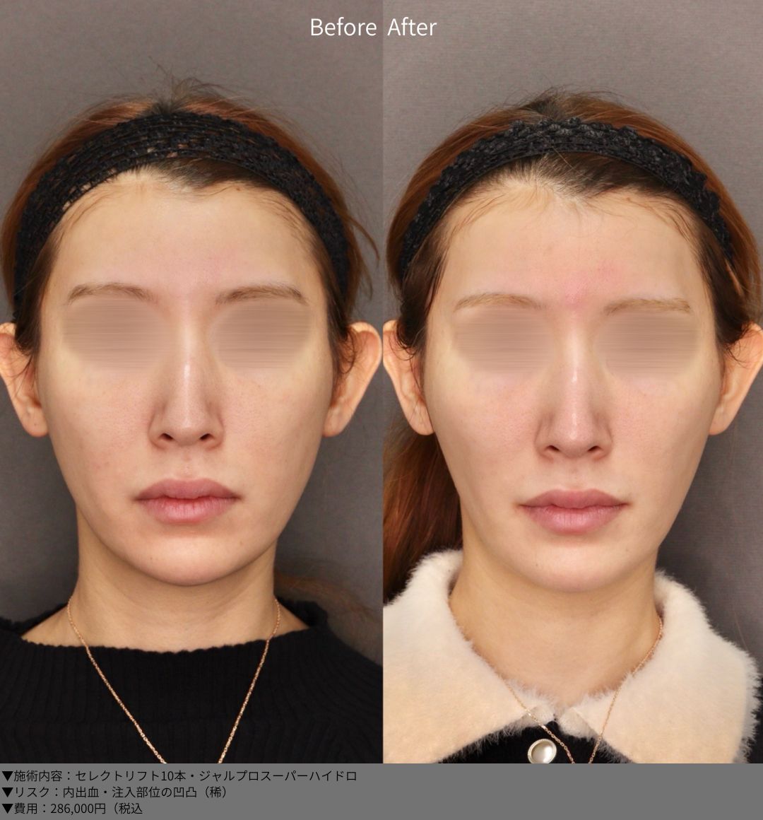 セレクトリフト ジャルプロスーパーハイドロ