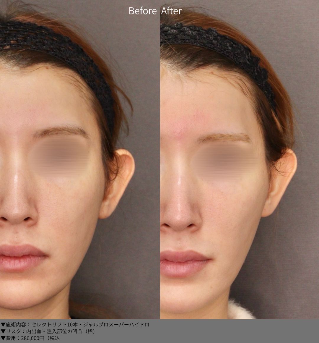 セレクトリフト ジャルプロスーパーハイドロ