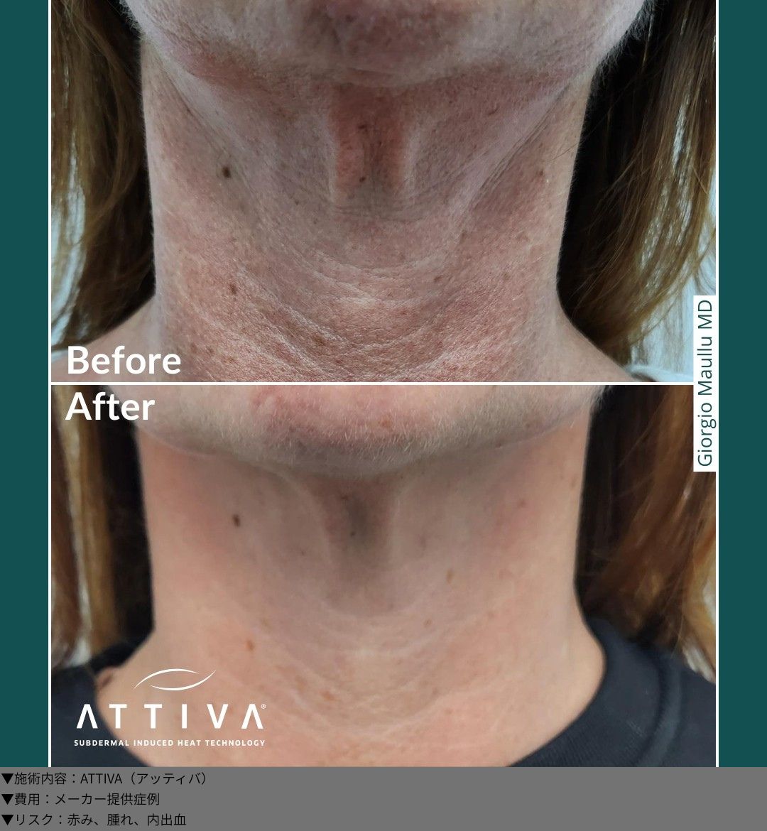 ATTIVA（アッティバ）