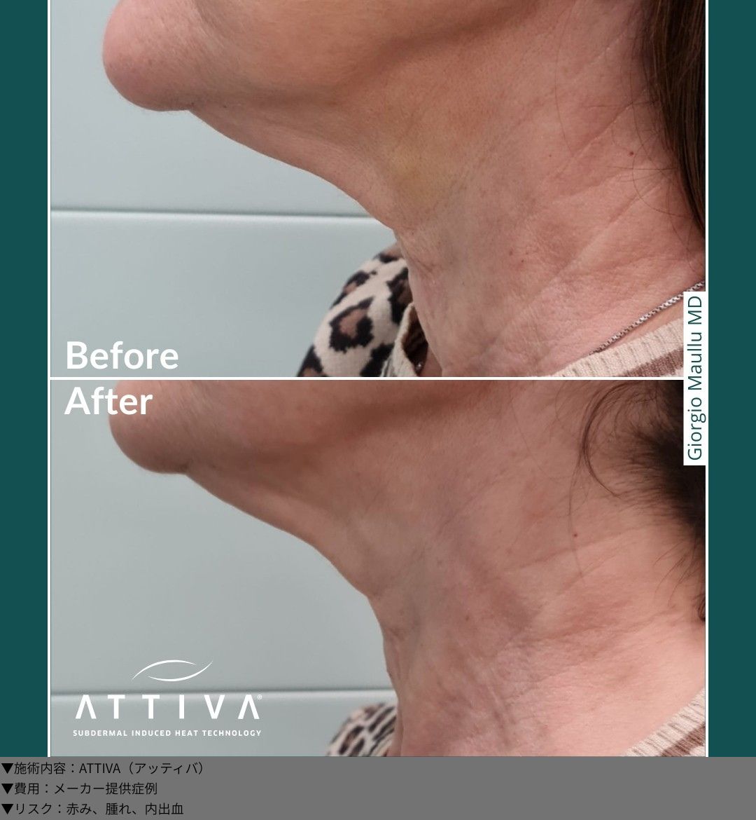 ATTIVA（アッティバ）