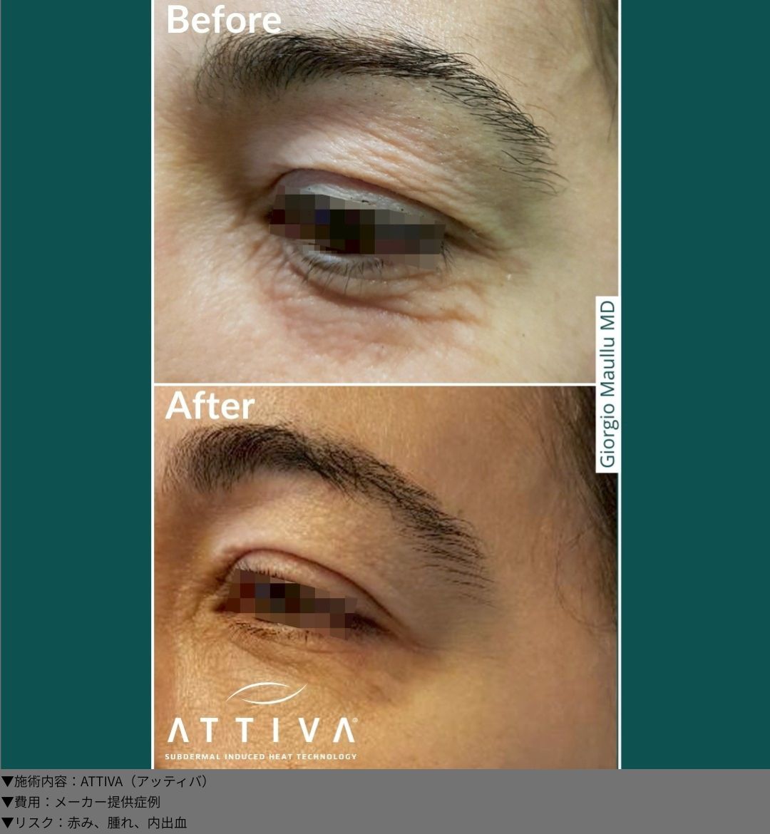 ATTIVA（アッティバ）