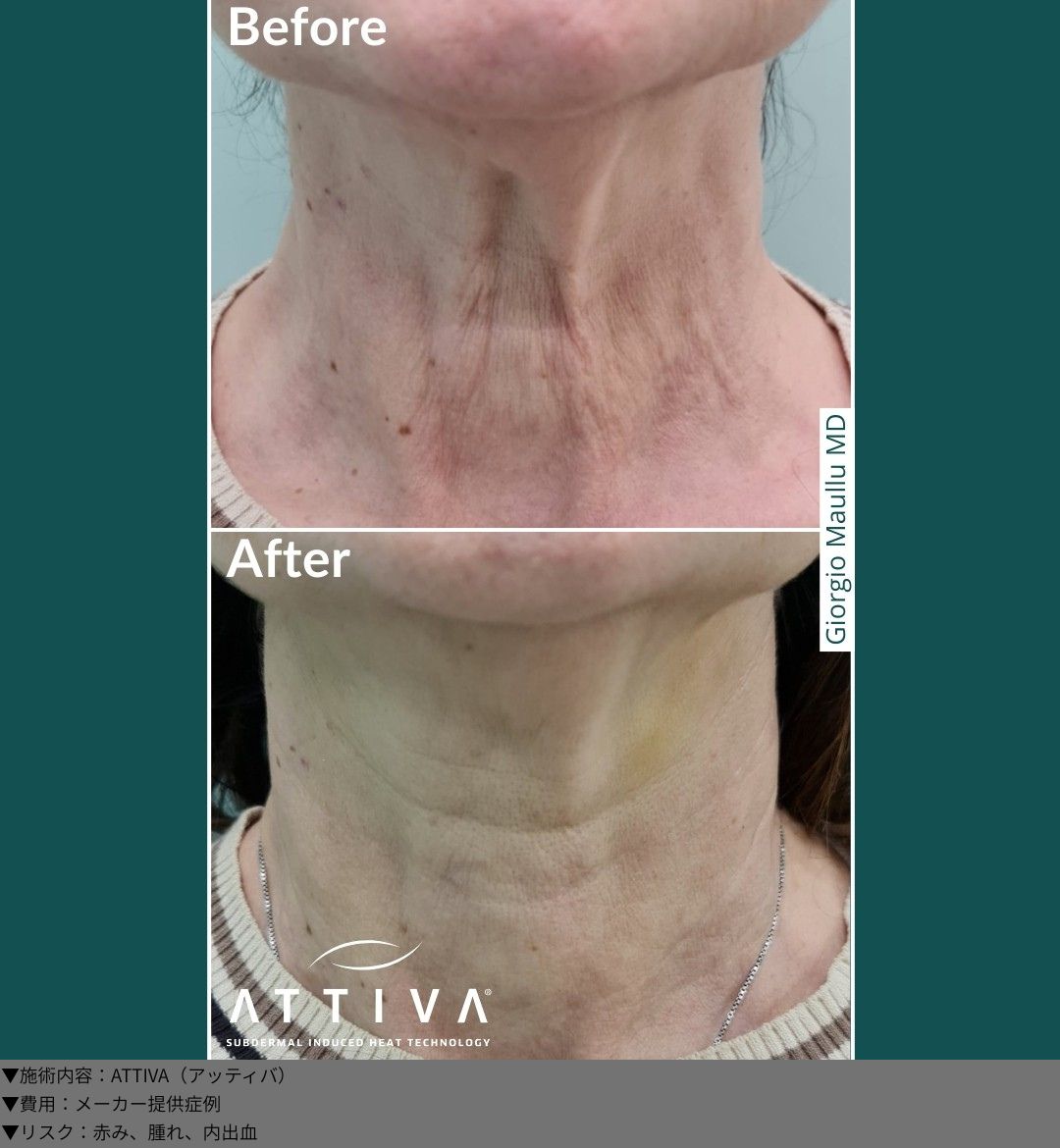 ATTIVA（アッティバ）