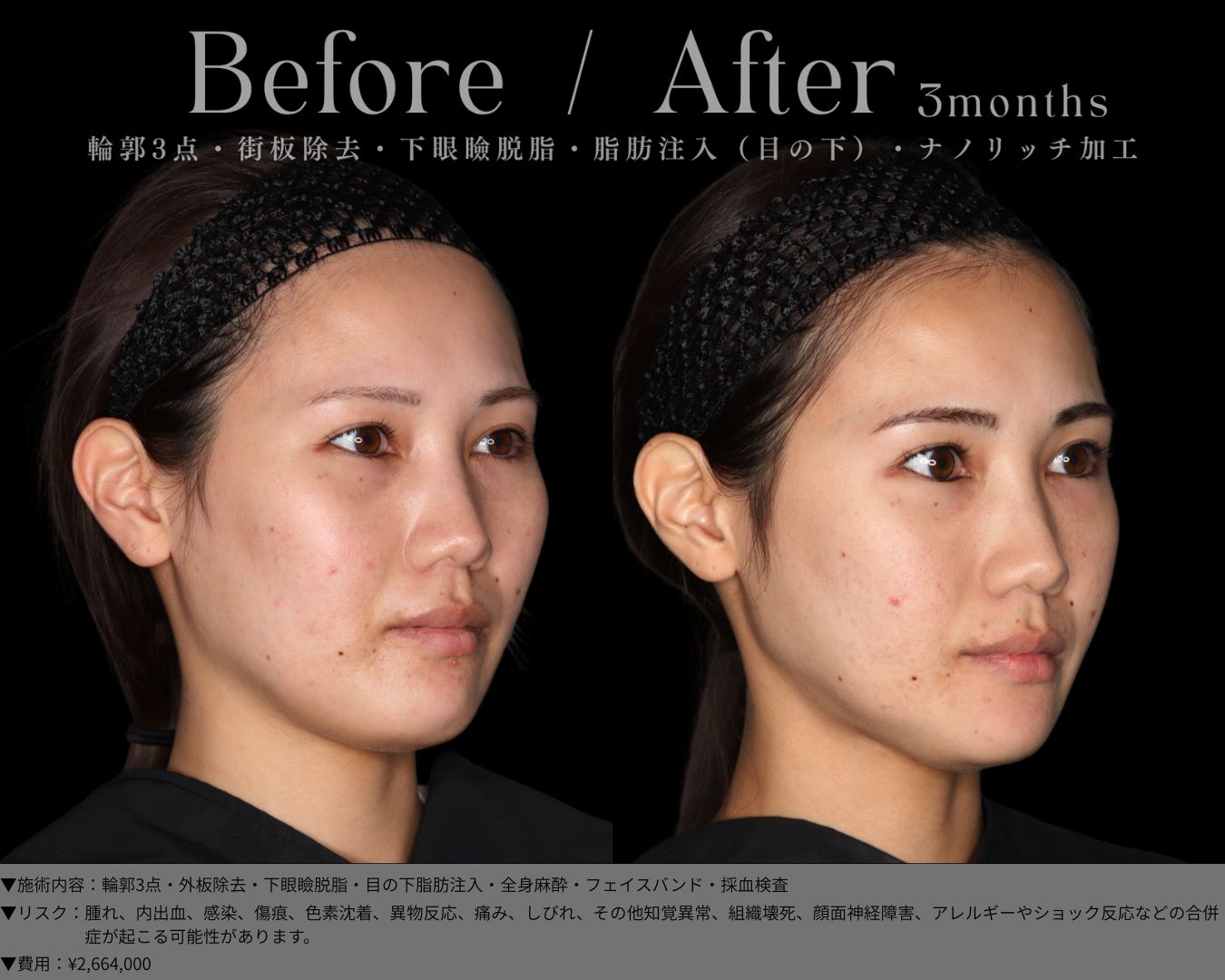輪郭3点・外板除去・下眼瞼脱脂・目の下脂肪注入・全身麻酔・フェイスバンド・採血検査