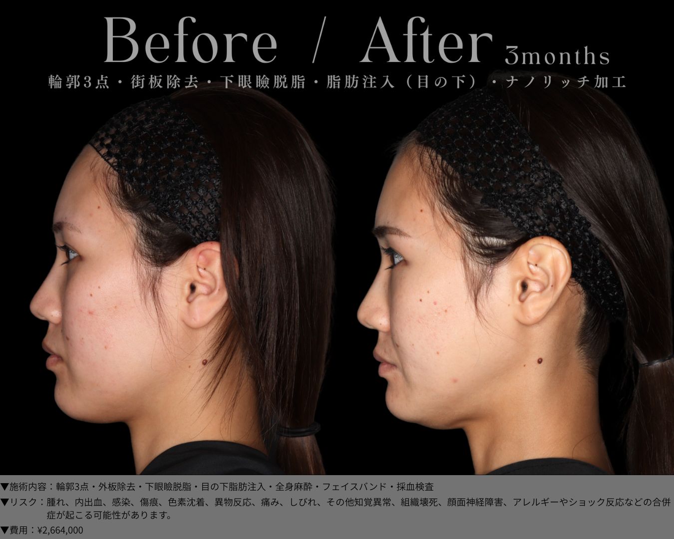 輪郭3点・外板除去・下眼瞼脱脂・目の下脂肪注入・全身麻酔・フェイスバンド・採血検査