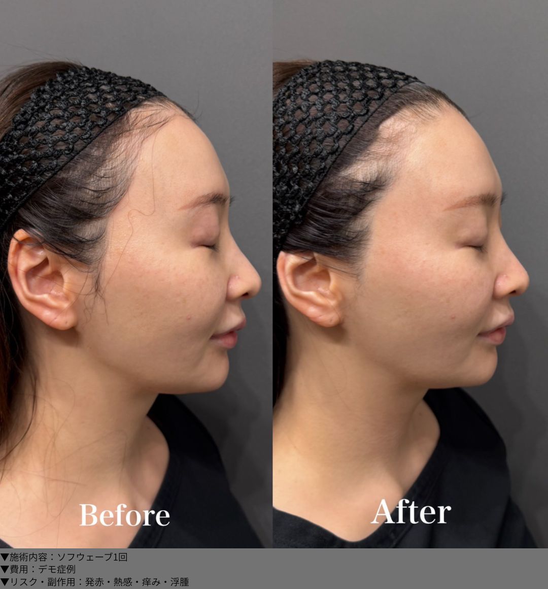 ソフウェーブ 症例