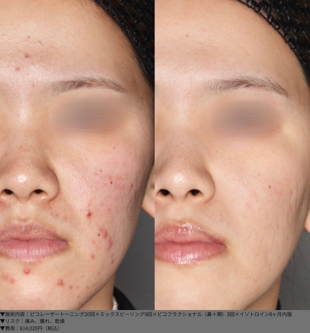 ピコレーザートーニング20回×ミックスピーリング9回×ピコフラクショナル（鼻＋頬）3回×イソトロイン8ヶ月内服