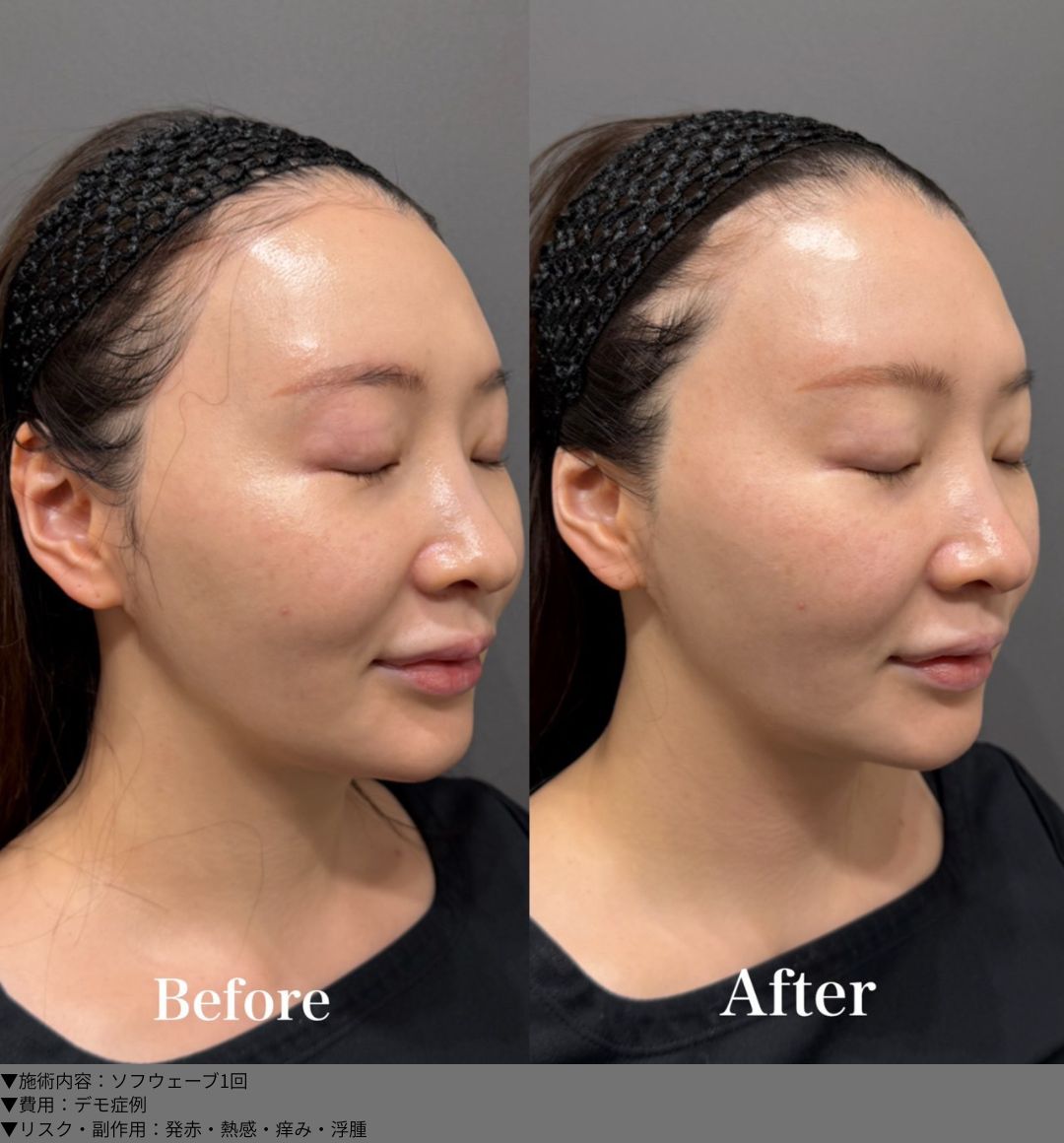 ソフウェーブ 症例