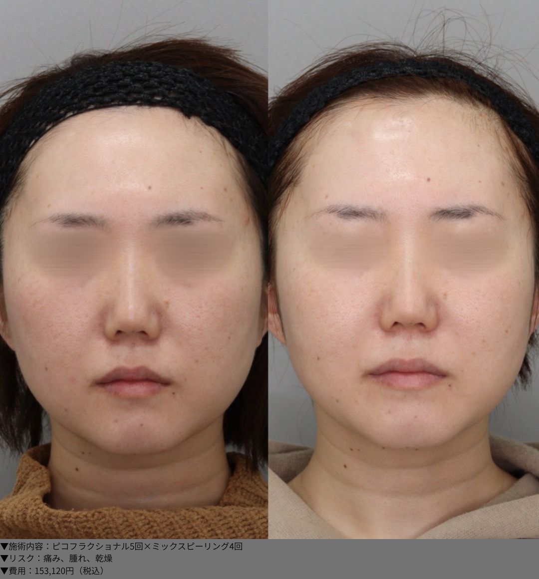 ピコフラクショナル5回×ミックスピーリング4回