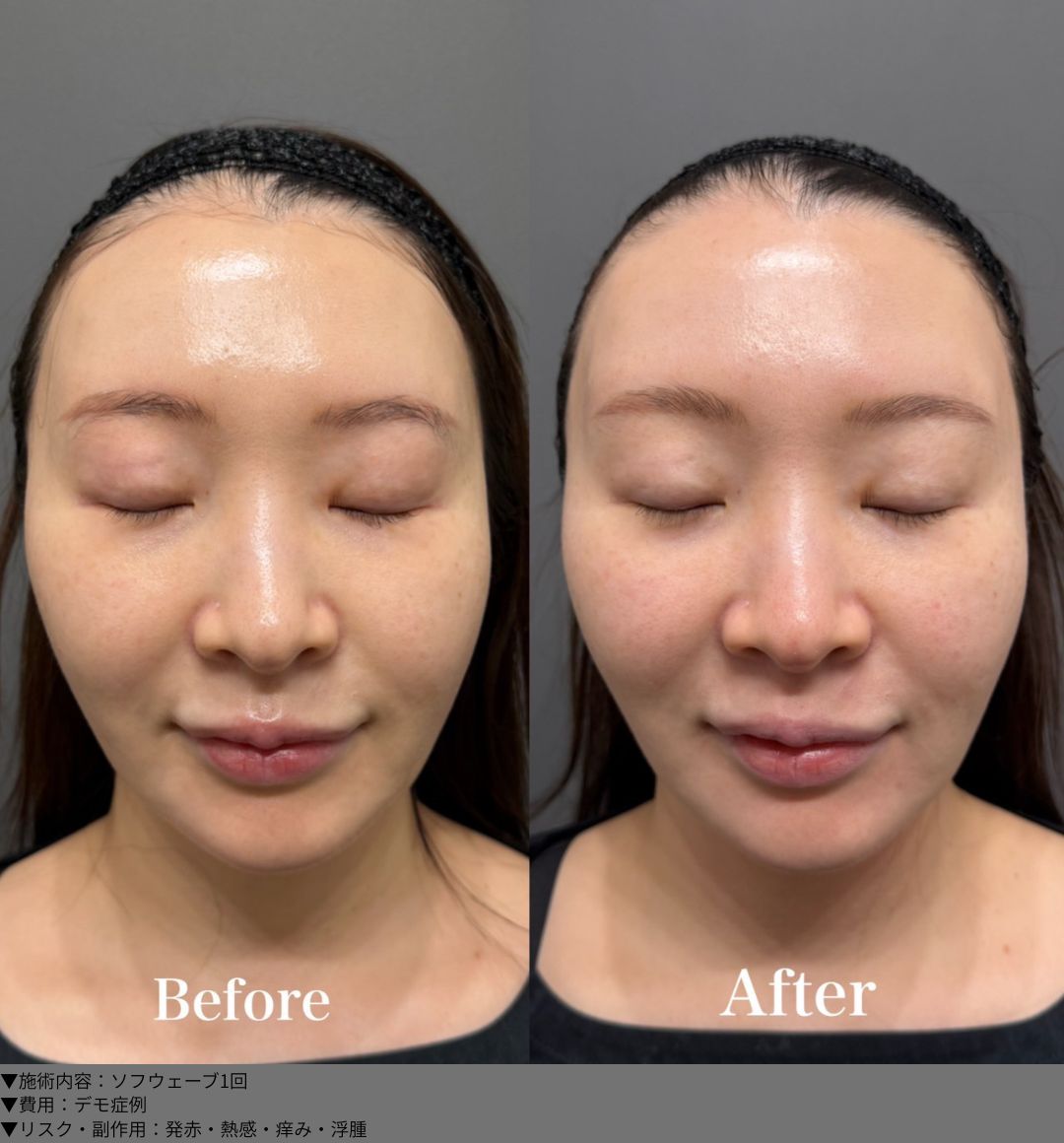 ソフウェーブ 症例