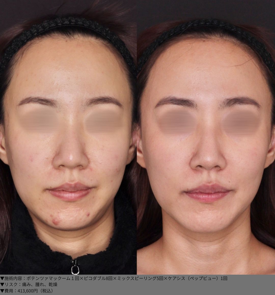 ポテンツァマックーム１回×ピコダブル8回×ミックスピーリング5回×ケアシス（ペップビュー）1回