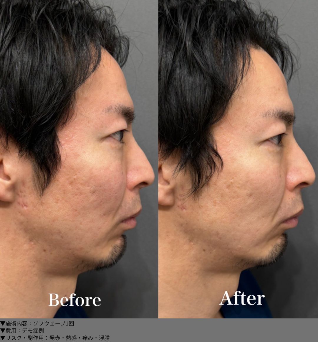 ソフウェーブ 症例