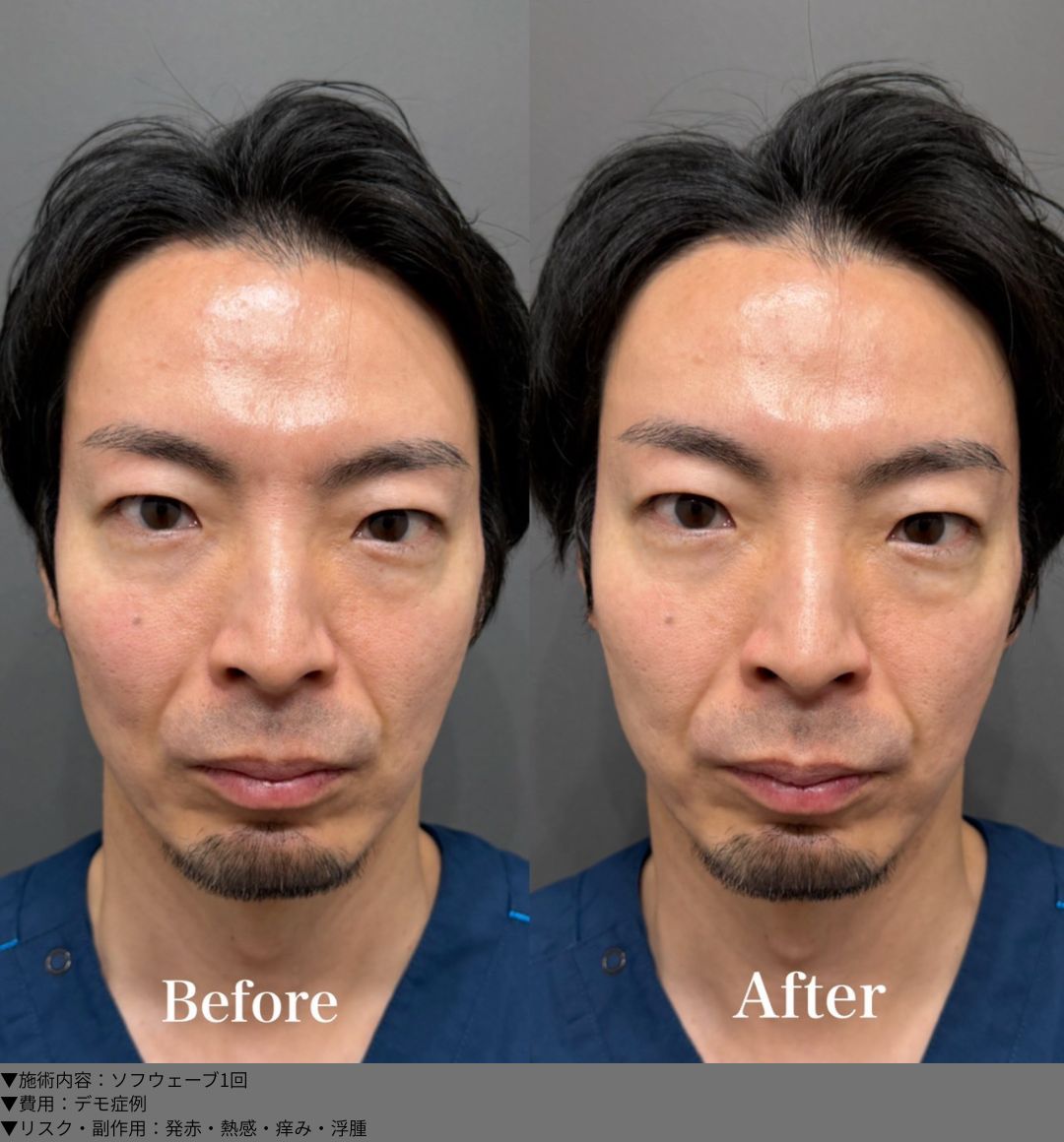 ソフウェーブ 症例