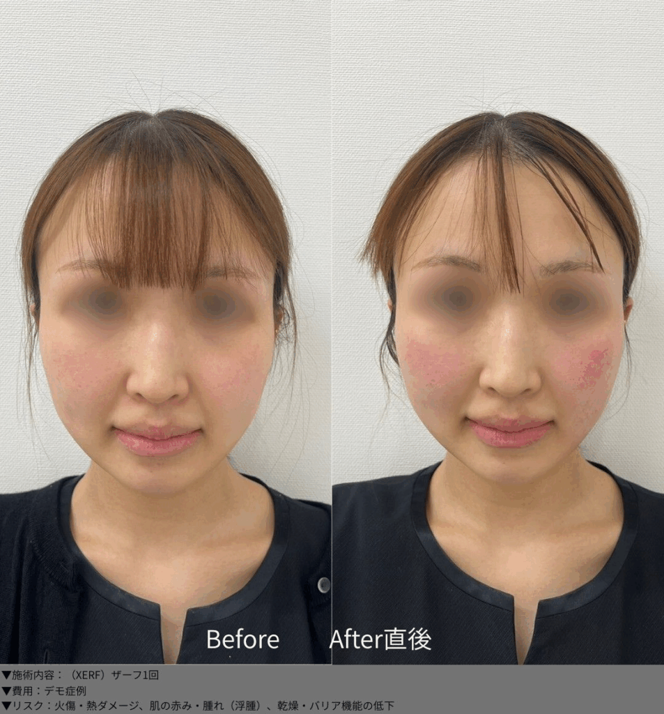 XERF(ザーフ) 症例