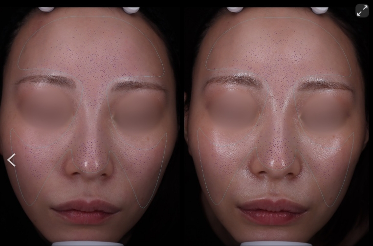 VISIA肌診断 医師監修のパック 前後 症例