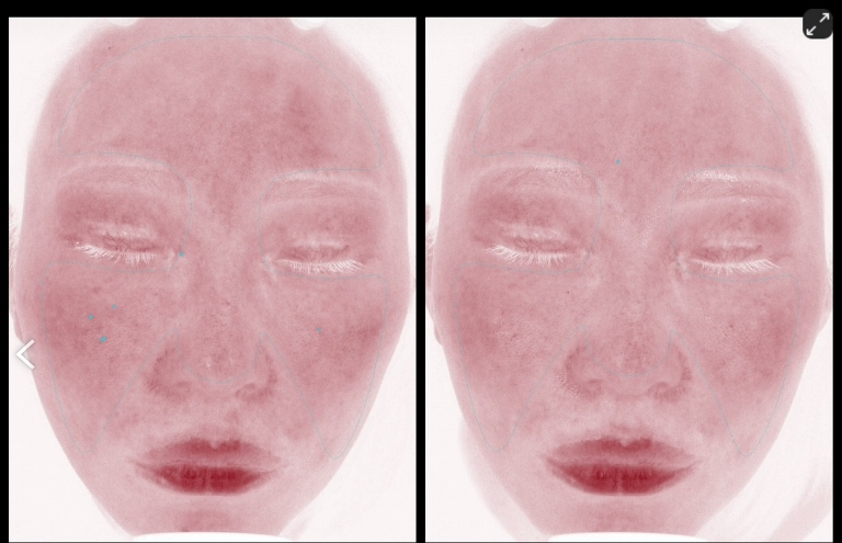 VISIA肌診断 医師監修のパック 前後 症例