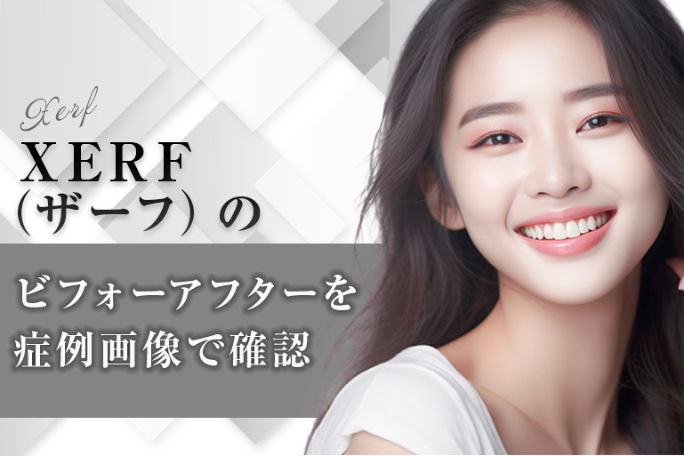 XERF（ザーフ） 症例 ビフォーアフター