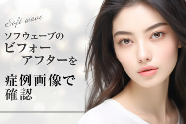 ソフウェーブのビフォーアフターを症例画像で確認