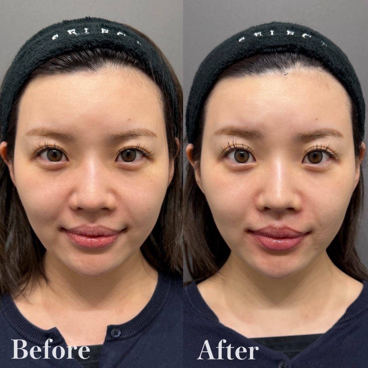 ソフウェーブ 症例 ビフォーアフター